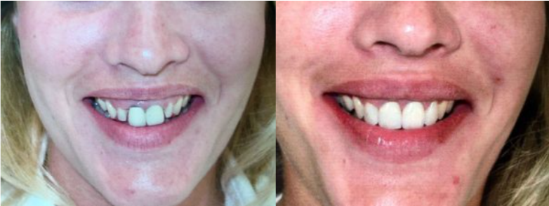 Smile Gallery. Dentist in Granger, IN. Dr. Thomas Anglemire, DDS, Dr. Ross J. Schafer, DDS. Granger Family Dentistry