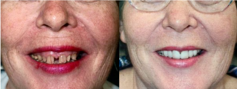 Smile Gallery. Dentist in Granger, IN. Dr. Thomas Anglemire, DDS, Dr. Ross J. Schafer, DDS. Granger Family Dentistry