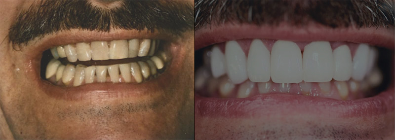 Smile Gallery. Dentist in Granger, IN. Dr. Thomas Anglemire, DDS, Dr. Ross J. Schafer, DDS. Granger Family Dentistry