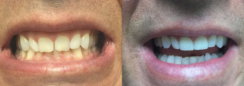 Smile Gallery. Dentist in Granger, IN. Dr. Thomas Anglemire, DDS, Dr. Ross J. Schafer, DDS. Granger Family Dentistry